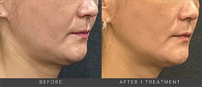 before and after DENZA treatment