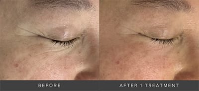 before and after DENZA treatment