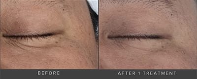before and after DENZA treatment